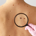 Melanoma: câncer de pele mais agressivo pode surgir de uma simples pinta e preocupa especialistas